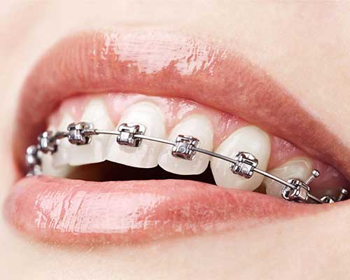 sabit ortodonti
